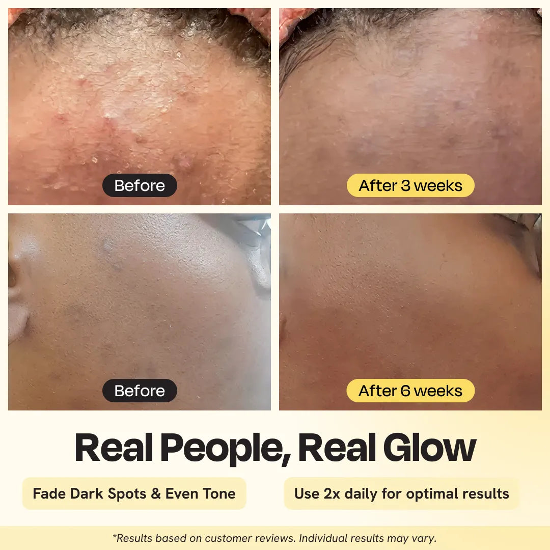 Moisturizer for dark spots and hydration and even tone